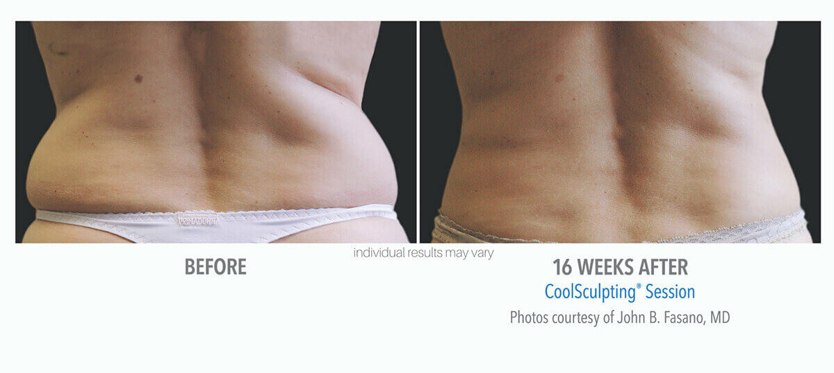 coolsculpting new jersey