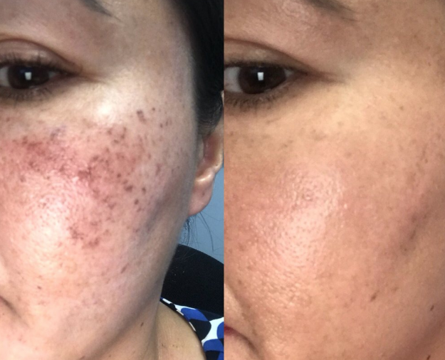 microneedling with prp