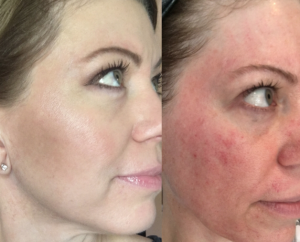 microneedling with prp